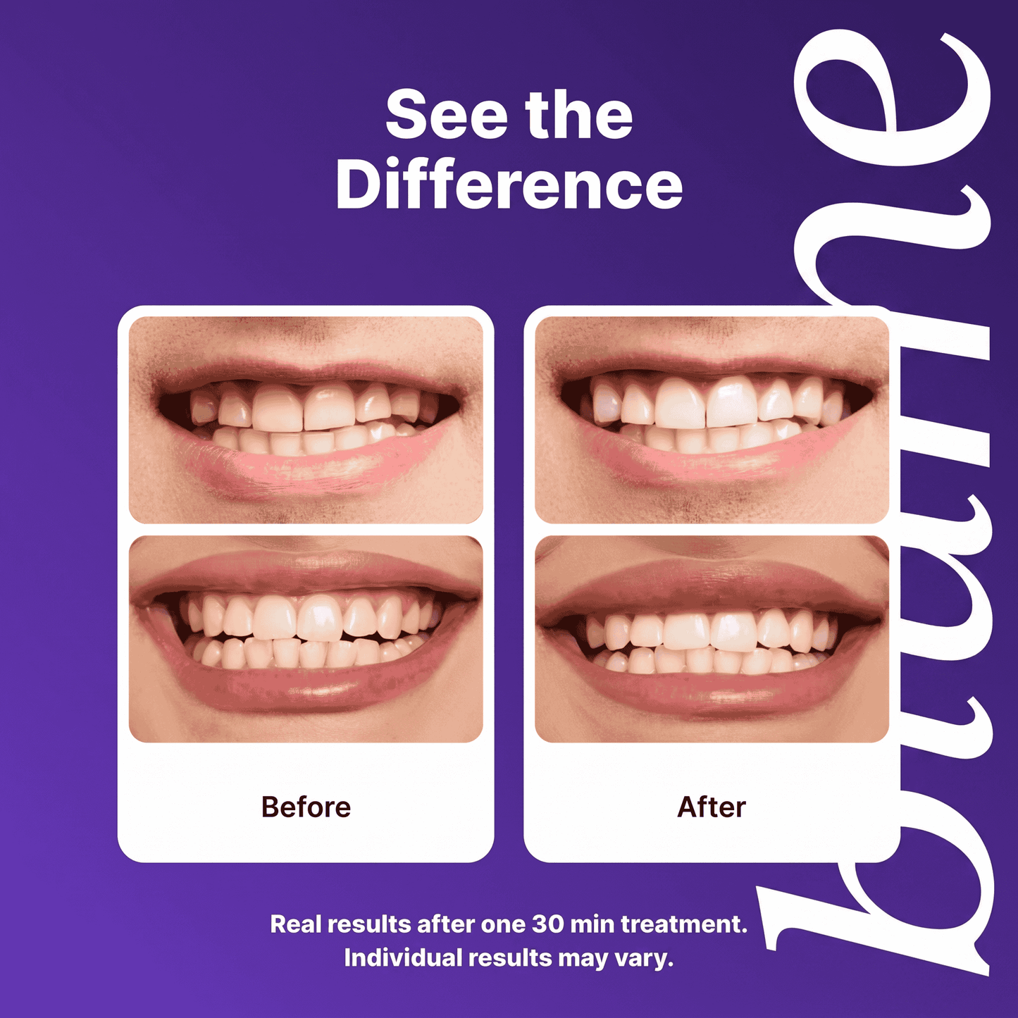 Blume Whitening Strips