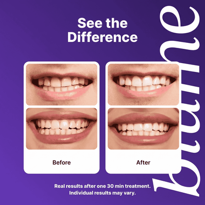 Blume Whitening Strips